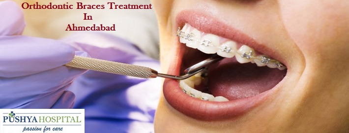 Orthodontic Braces Treatment In Ahmedabad